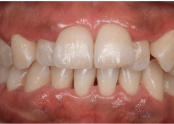 ¿Tiene relación la inflamación de las encías con el Alzheimer?